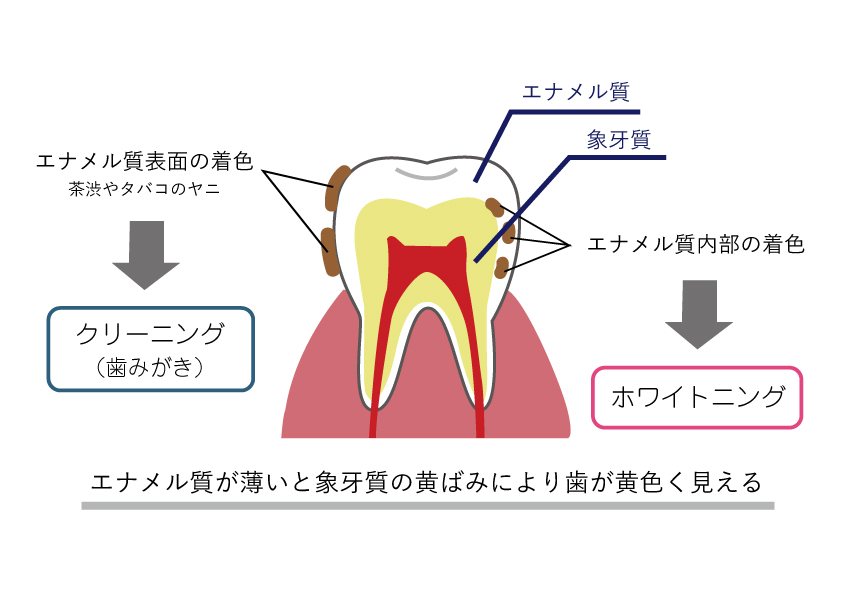 歯の黄ばみの原因