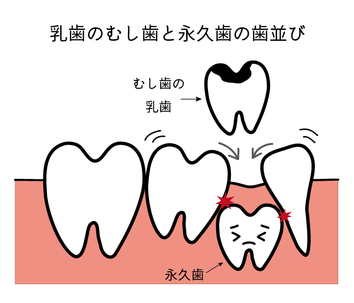 乳歯のむし歯と永久歯の歯並び