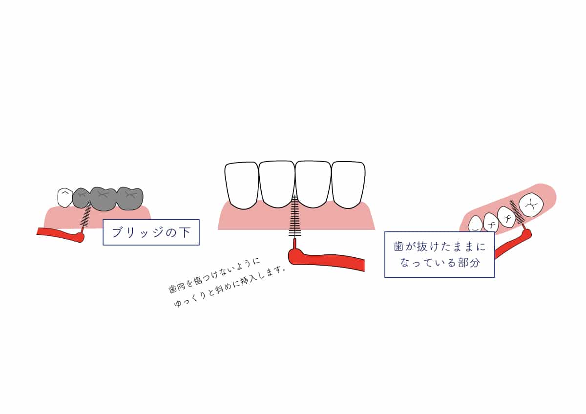 御笠川デンタルクリニック ヒカリの歯間ブラシ