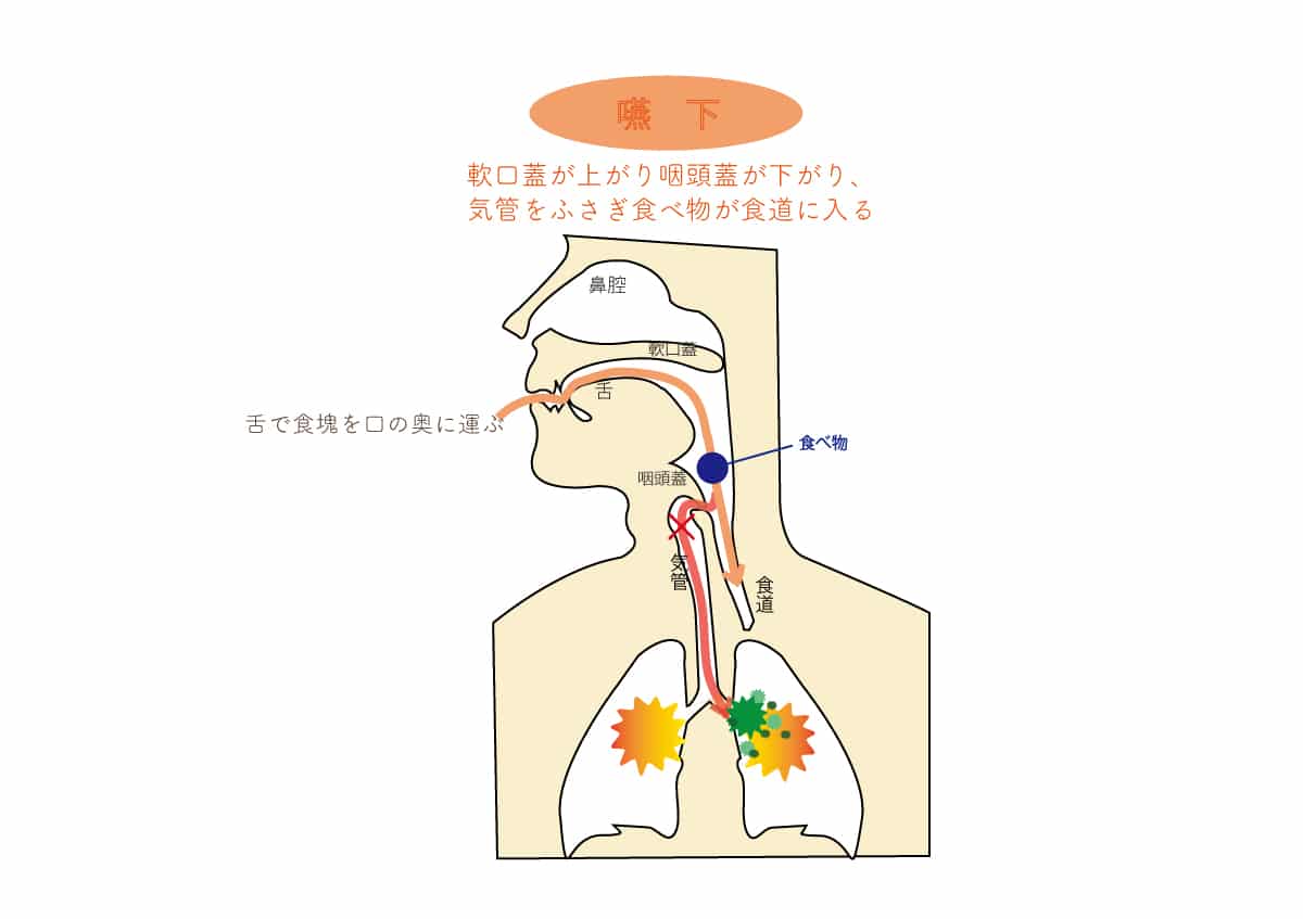 訪問診療コラム 誤嚥性肺炎 御笠川デンタルクリニック ヒカリ 大野城市の歯科医院