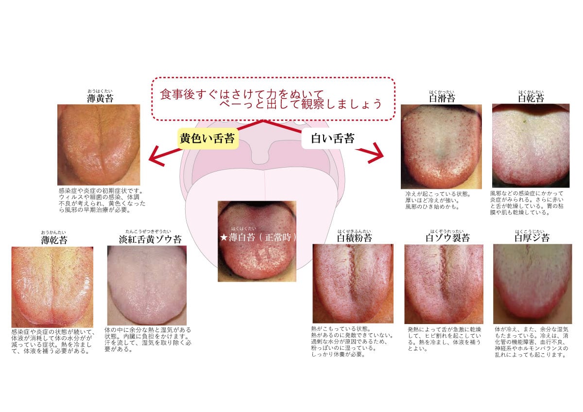 訪問診療コラム 舌の色をみていますか 白い舌苔 黄色い舌苔 御笠川デンタルクリニック ヒカリ 大野城市の歯科医院